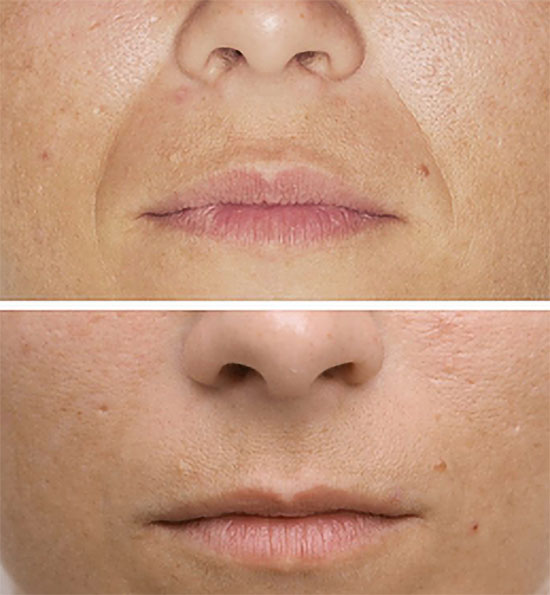 Plasma Fibroblast Opulent Aesthetics White Plains Ny